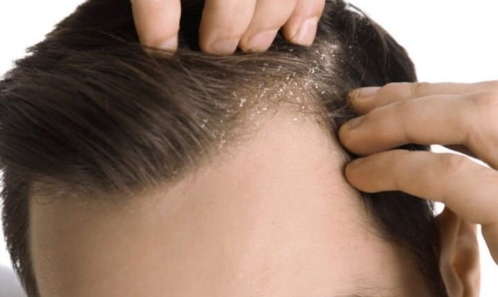 دلایل-شوره-سر-چیست؟-چگونه-از-شر-آن-خلاص-شوید؟